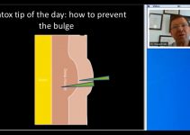 Prevent The Bulge Side Effect